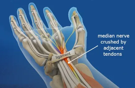 inside the carpal tunnel