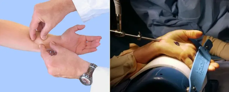 myofascial massage vs carpal tunnel surgery