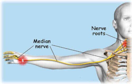 median nerve pain