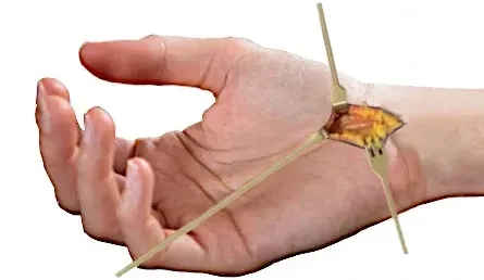 carpal tunnel surgery