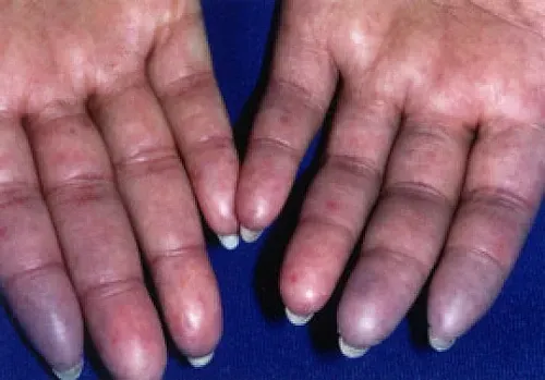 scleroderma in fingers