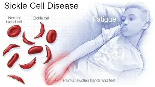 sickle cell disease