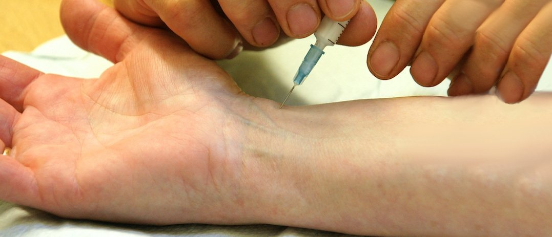 carpal tunnel steroid injection