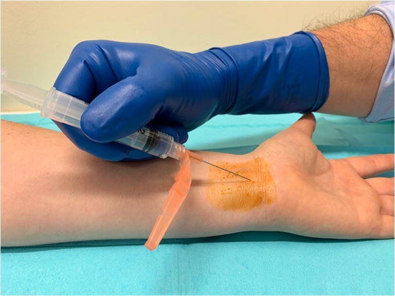 steroid shot for carpal tunnel