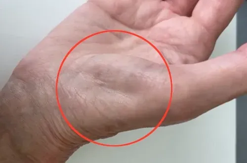 thenar atrophy