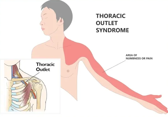 diagram of thoracic outlet syndrome