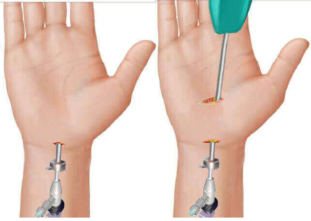 2 types of endoscopic carpal tunnel surgery