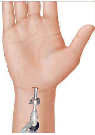 single portal endosopic carpal tunnel surgery