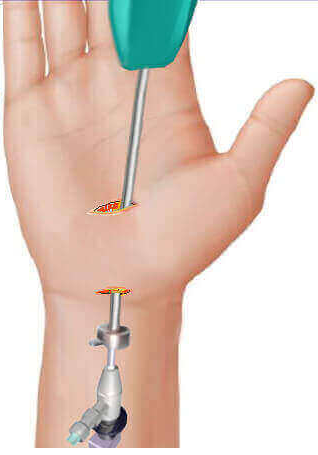double portal endosopic carpal tunnel surgery