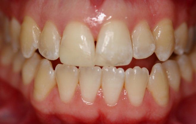 after broken tooth treatment