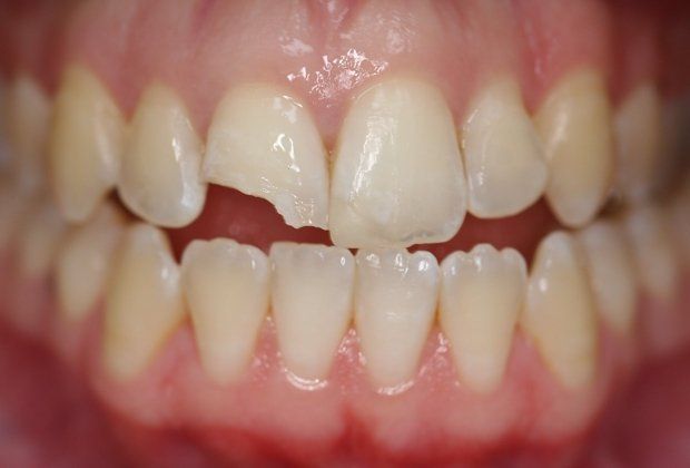 before broken tooth treatment