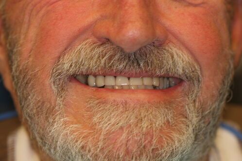 After - Dental Crown