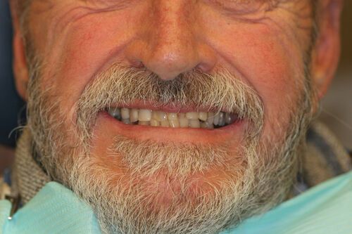Before - Dental Crown
