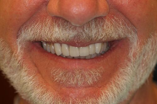 after dental veneers treatment