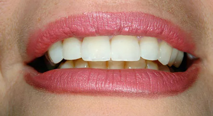After - Zoom! Teeth Whitening
