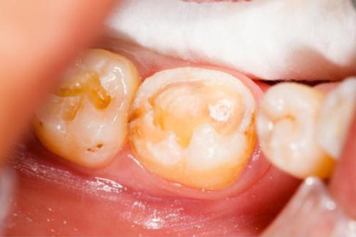 Close-up of a molar with a large dental filling, surrounded by gingiva, under a dental dam. The tooth is stained and discolored.