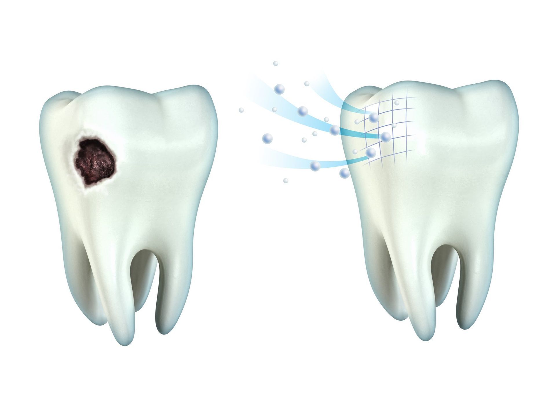 teeth cavity