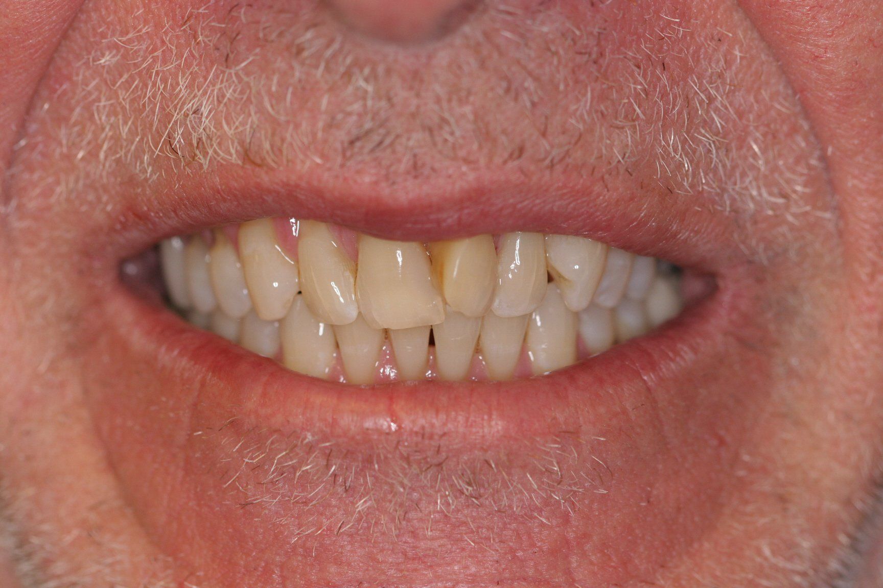 before dental veneers treatment