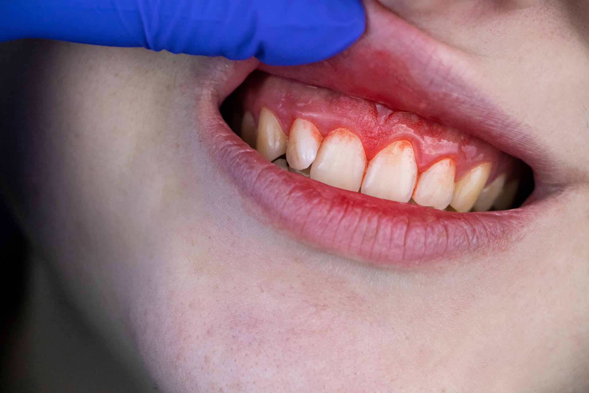 dentist examining gum bleeding and inflammation