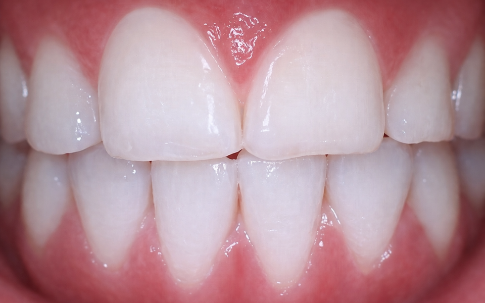 After Smile Gallery