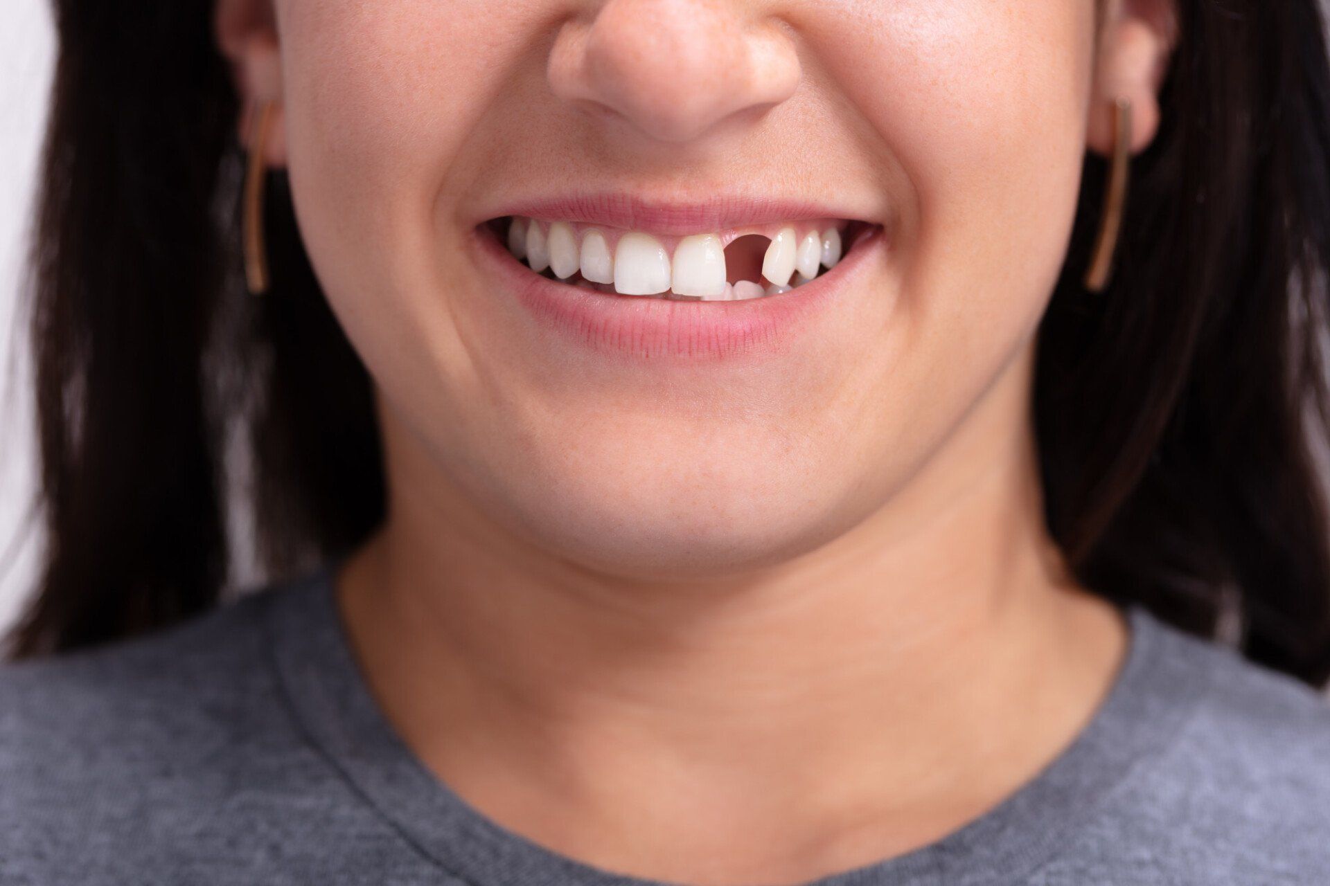 lost teeth