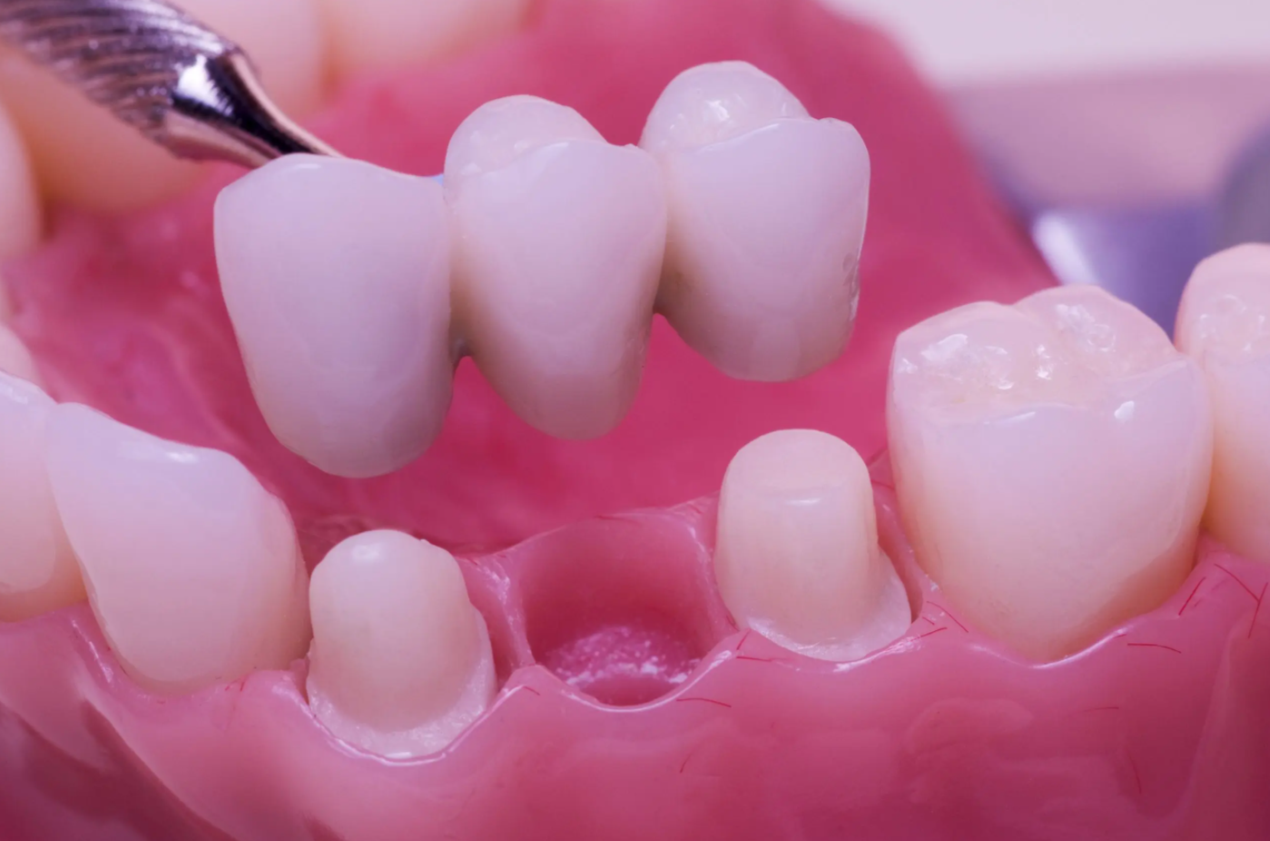 dental bridge creation
