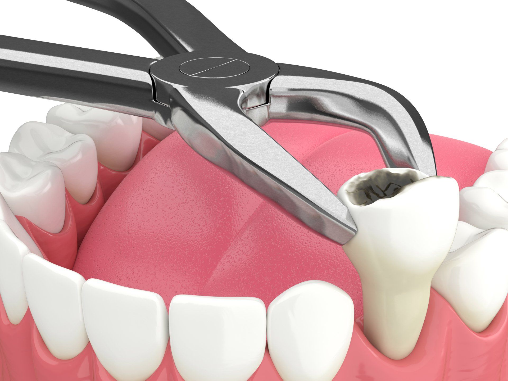 Dental forceps removing a tooth in a pink gums model, with surrounding white teeth visible