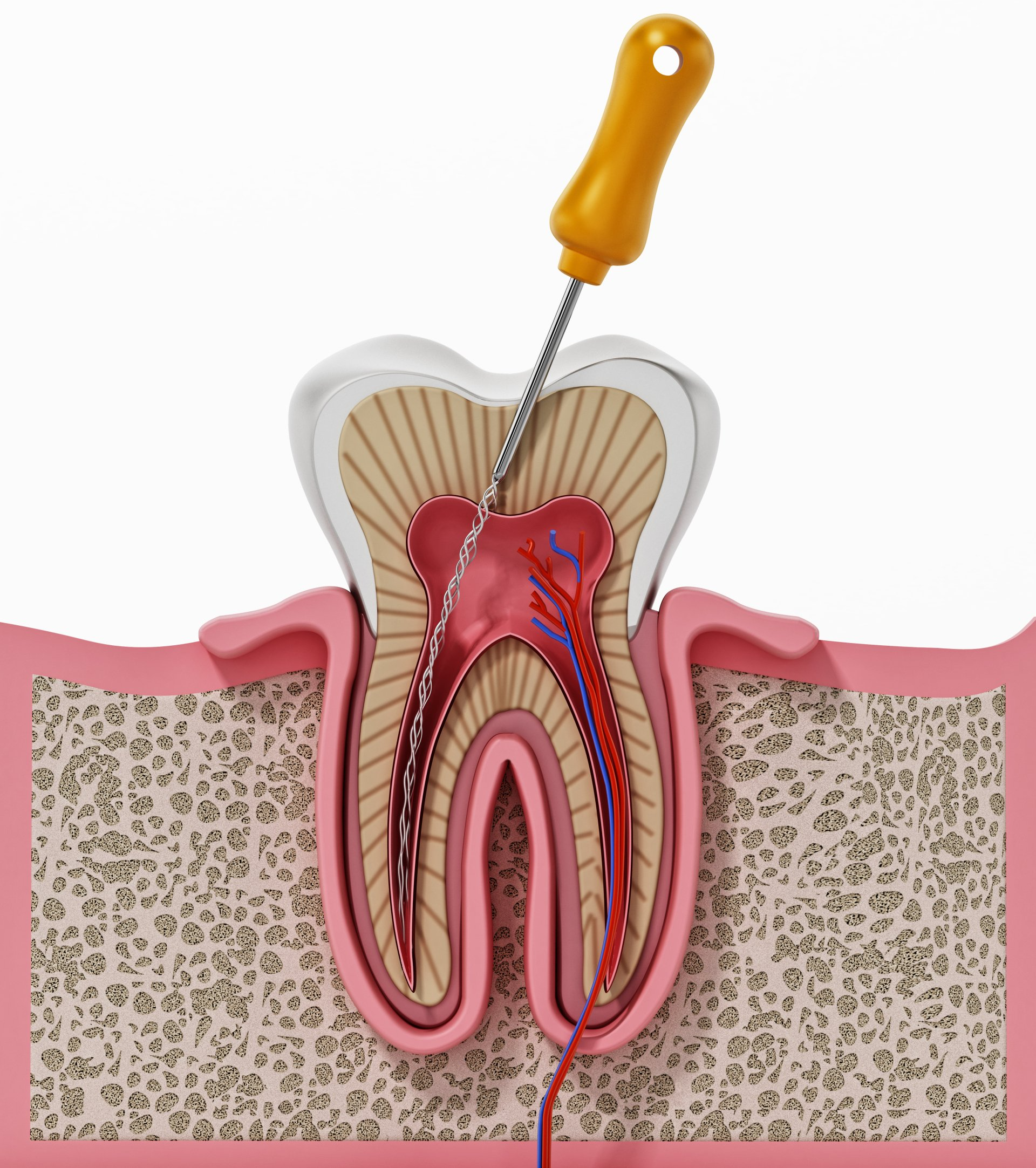 root canal treatment model