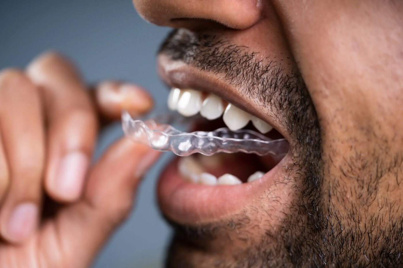 clear correct patient inserting clear tray