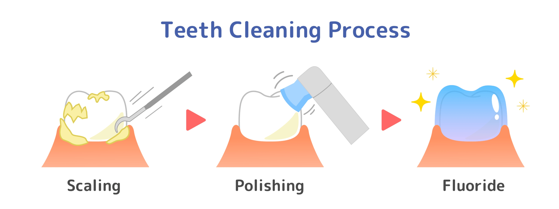 Diagram of teeth cleaning process: scaling, polishing, and fluoride, shown with dental tools and a tooth icon.