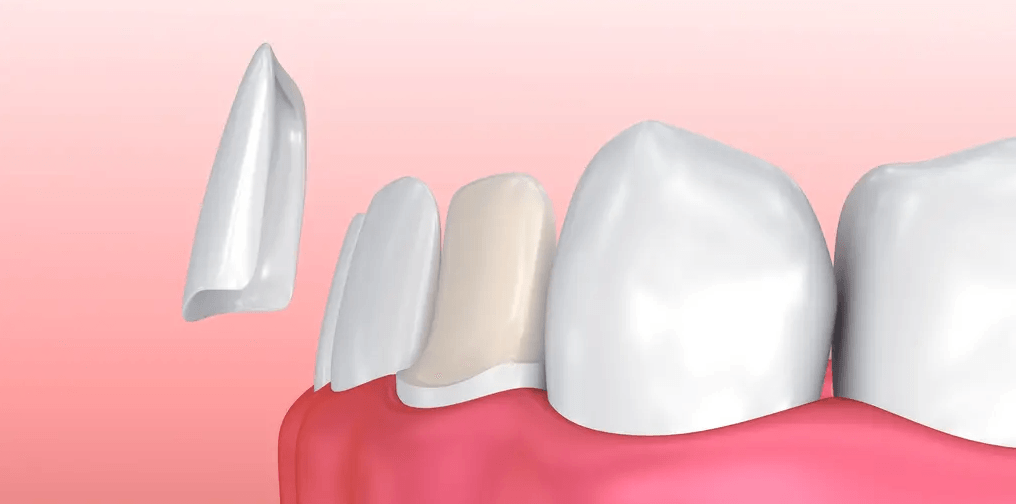 3D dental illustration of a detached front tooth next to a row of teeth and pink gums