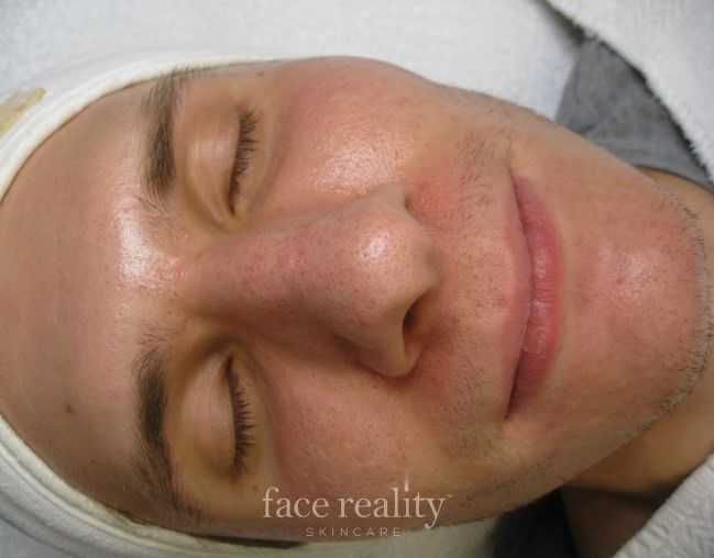 Man with closed eyes and red skin, likely after a facial treatment. Close-up shot.