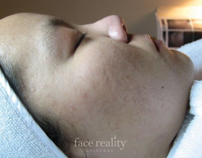 Woman's face, eyes closed, lying down with a towel; visible acne on cheek, chin, and jawline; Face Reality logo.