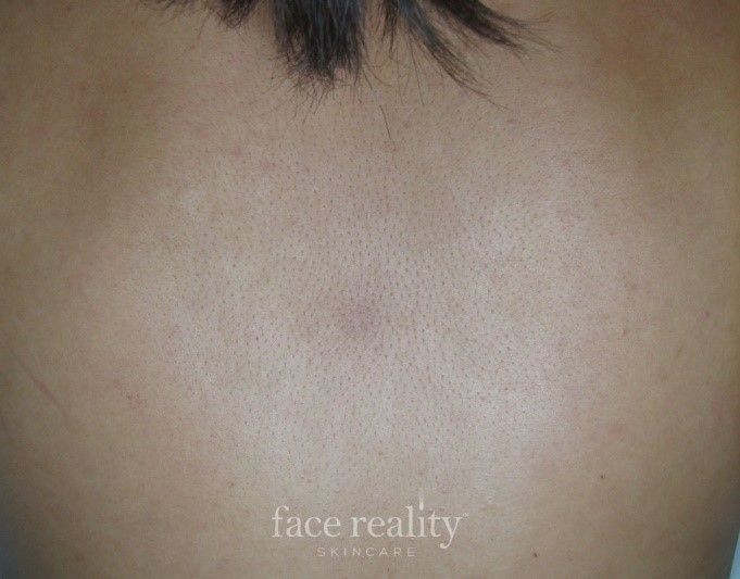 Back with skin texture and small dark hairs at the nape of the neck.