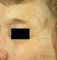 Close-up of an older person's face, showing wrinkles around the eye, with a black box covering the eye itself.