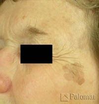 Close-up of a person's face showing a brown skin lesion near the eye and fine lines extending from it.
