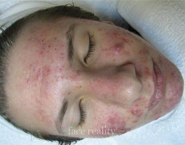 A person's face with severe acne, red bumps, and blemishes. Eyes closed, in a white towel.