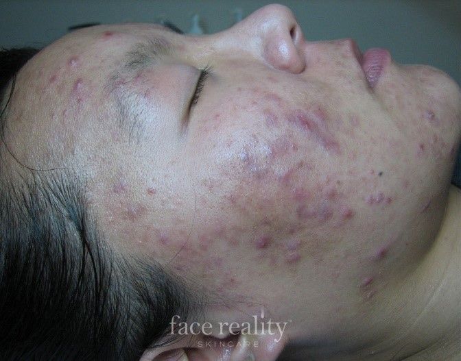 Person with acne on their face, with many red and purple blemishes on their cheeks, forehead and temples.