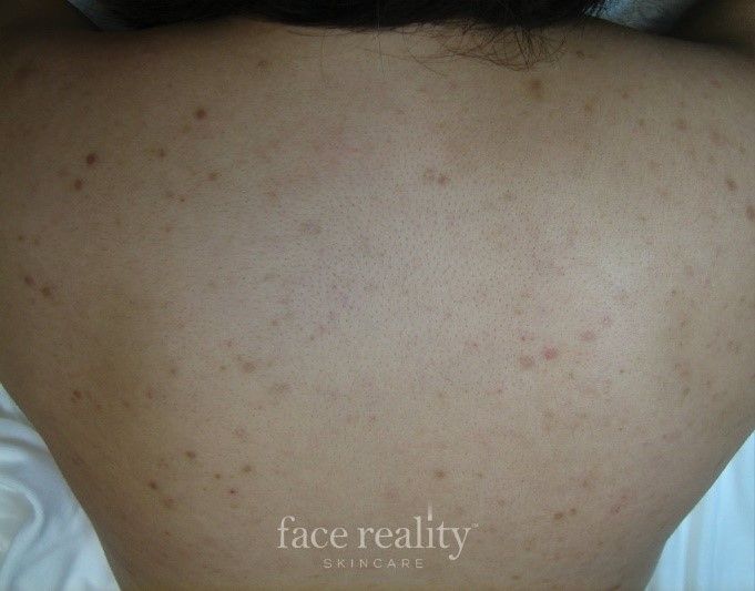 Back with scattered brown spots, potential acne scars.