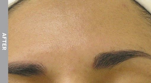 Close-up of a person's forehead and eyebrows; even skin tone; shaped, dark eyebrows, 