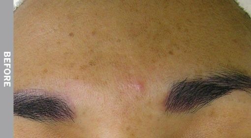 Forehead with a scar and eyebrow, labeled 