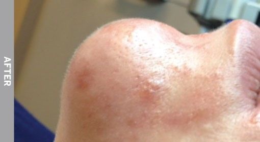 Close-up of skin after a treatment. Redness and small bumps are visible on the skin's surface.