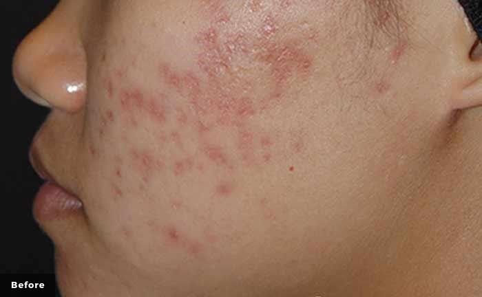 Person's face with acne: red, inflamed skin with visible pimples, particularly on the cheek.