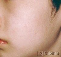 Close-up of a person's cheek and mouth, showing pale skin.