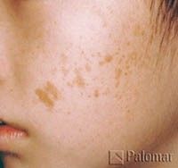 Close-up of person's cheek with light brown patches of melasma (hyperpigmentation).