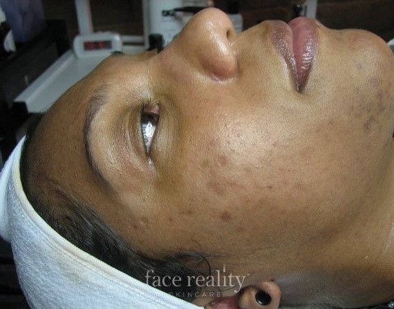 Woman with acne on her face, receiving skincare treatment, lying down.