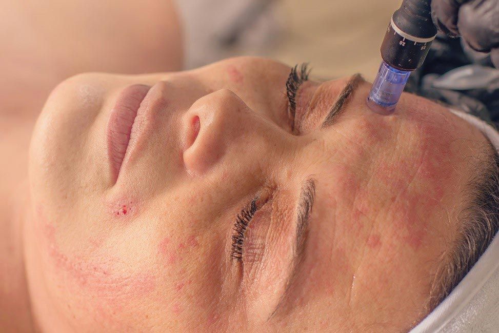 Person undergoing microneedling facial treatment. Red, swollen skin and a device with needles near the face.