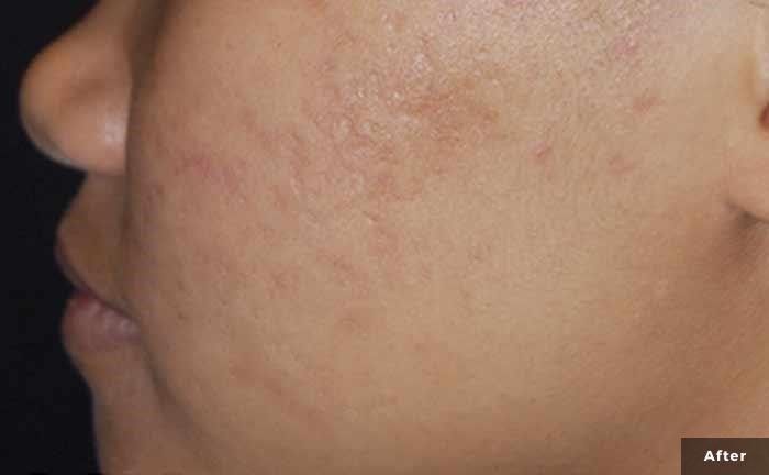 Side profile of a person's face; showing acne scarring and smoother skin after treatment.
