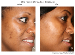 Before-and-after photos of a woman's face; left side shows acne scars; right side, clear skin after a derma peel treatment.