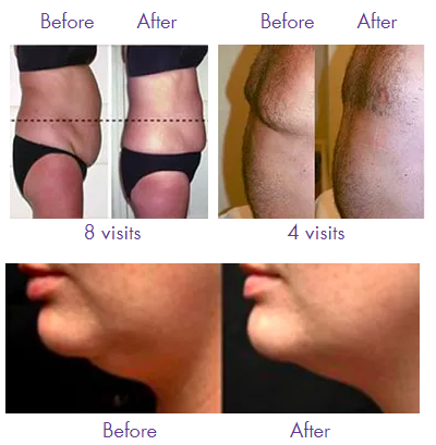Before and after body contouring photos: waist, abdomen, and chin. Done with lipo-light body sculpting system.